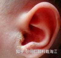 耳朵外圍癢 壬辰年2012